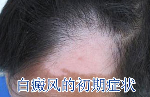 白癜风诊断依据是什么 白癜风诊断依据是什么