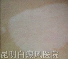 局限性白癜风怎么治 局限性白癜风怎么治