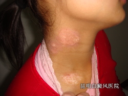 治疗白癜风的 佳方法