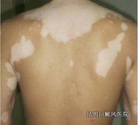 白癜风初期能治吗